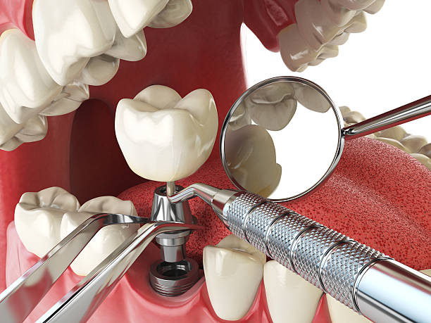 Best Emergency Broken Tooth Repair in Okawvle, IL